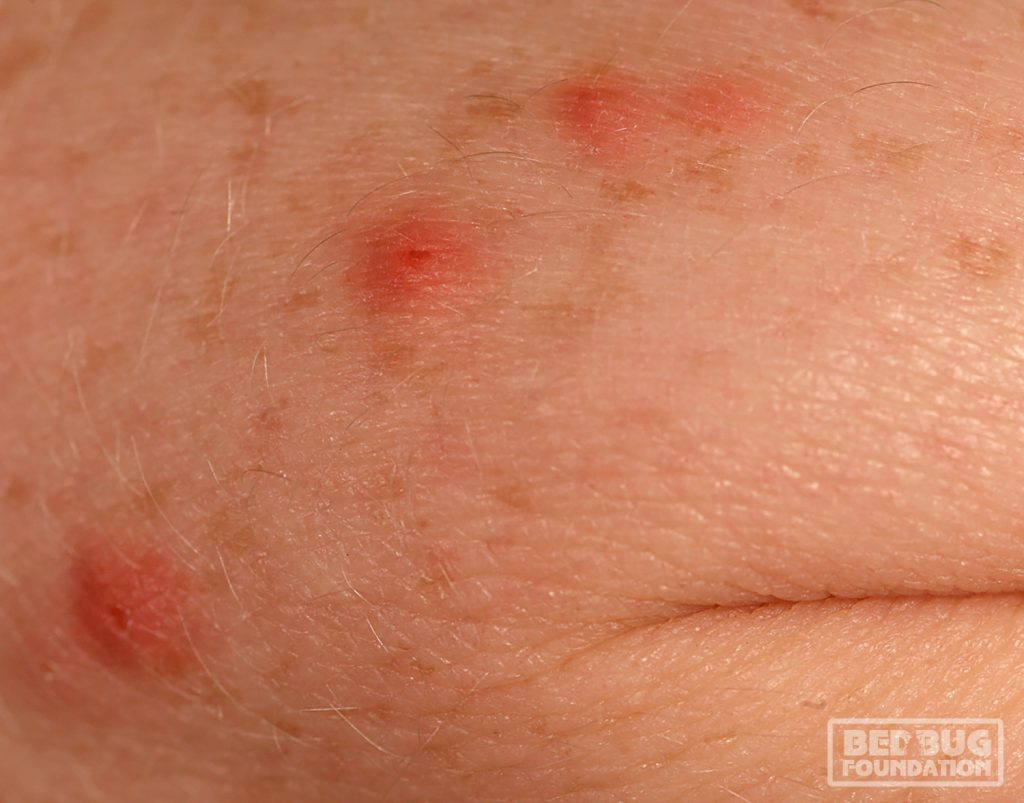 Step 1 Confirmation Bed Bug FoundationBed Bug Foundation Step 1 Confirmation Bed Bug FoundationBed Bug Foundation